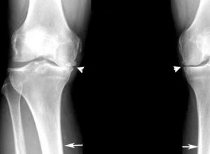 Восстановление хрящевой ткани коленного сустава